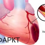 Precursors of myocardial infarction: symptoms and first signs