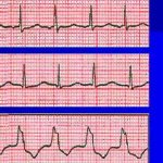 Causes and forms of atrial fibrillation