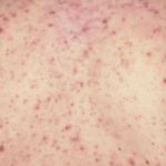 Причины появления и лечение потницы у взрослых