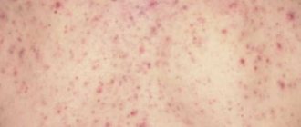 Causes and treatment of prickly heat in adults
