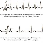 Причины симптомы и лечение пароксизмальной тахикардии последствия