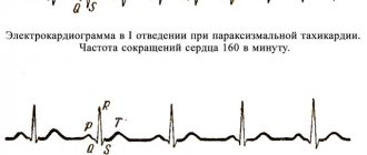 Причины симптомы и лечение пароксизмальной тахикардии последствия