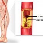 Signs of a blood clot in the leg symptoms