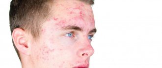 problematic skin