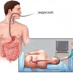 Performing an endoscopic procedure