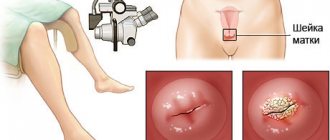 performing colposcopy of the cervix