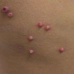 Manifestation of molluscum contagiosum