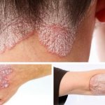 псориаз на теле