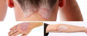 psoriasis on the body