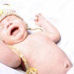 Umbilical hernia in children