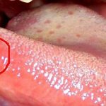 spots on the side of the tongue
