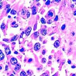 Rhabdomyosarcoma - symptoms and treatment, photos and videos.