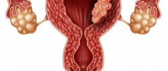 Endometrial cancer can cause symptoms such as unexplained pain, fatigue, and heaviness in the pelvic area.