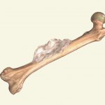 Bone cancer