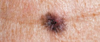 Skin cancer