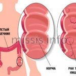 Рак толстой кишки