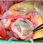 dissecting aortic aneurysm