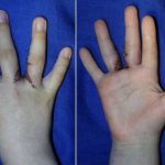 Разделение сросшихся пальцев