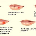 Development of labial herpes