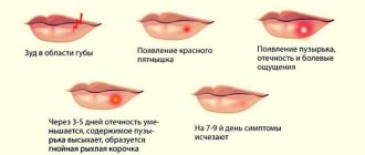 Development of labial herpes