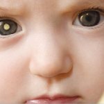 Ретинобластома у ребенка