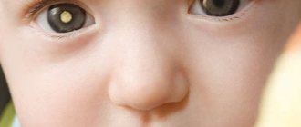 Retinoblastoma in a child