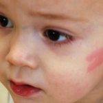Розовое пятно на лице у ребенка
