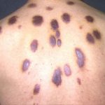 Kaposi&#39;s sarcoma