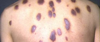 Kaposi&#39;s sarcoma