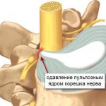 сдавление корешка нерва
