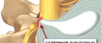 nerve root compression