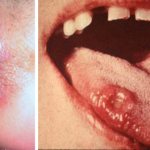 шанкры в области ануса и полости рта