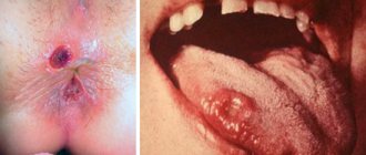 chancre in the anus and oral cavity