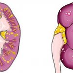 Scheme of acute pyelonephritis