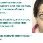 Симптом экзофтальм