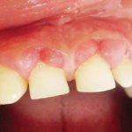 Symptoms, diagnosis and treatment of Vincent ulcerative necrotic gingivitis. What does AIDS have to do with it? 