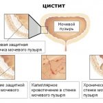 Симптомы хронического цистита у женщин
