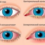 Симптомы и виды конъюнктивита