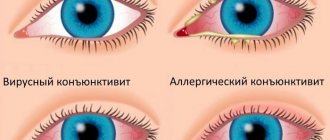 Symptoms and types of conjunctivitis