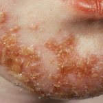 Симптомы импетиго