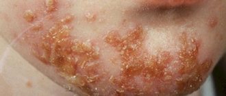 Symptoms of impetigo