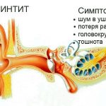 Symptoms of labyrinthitis