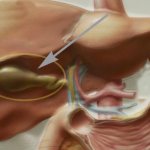 Symptoms of gallbladder cancer