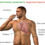 Симптомы сердечной недостаточности