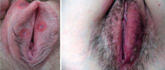 symptoms of syphilis on the labia