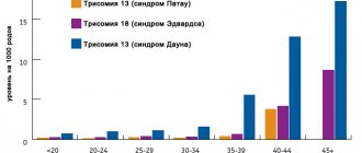синдром эдвардса фото