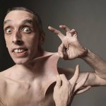 Ehlers Danlos syndrome - symptoms and treatment, photos and videos.