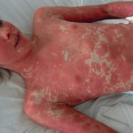 Lyell&#39;s syndrome - symptoms and treatment, photos and videos.