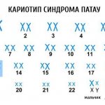 Синдром Патау - симптомы и лечение, фото и видео.