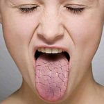 Синдром Шегрена